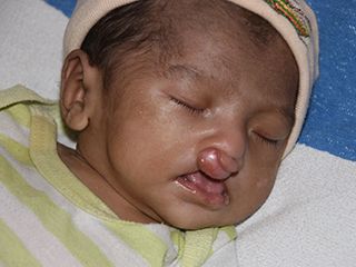 ifc cleft palate jose rodolfo