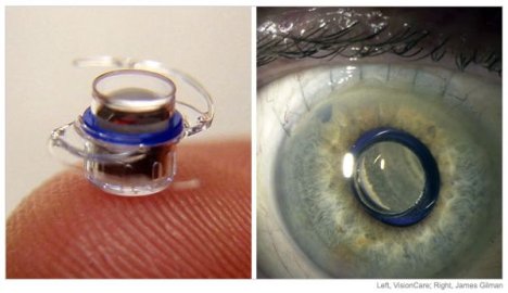 telescope-eye-implant