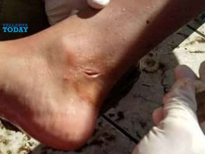 Sea Snakes In Guayabitos Bite Tourists